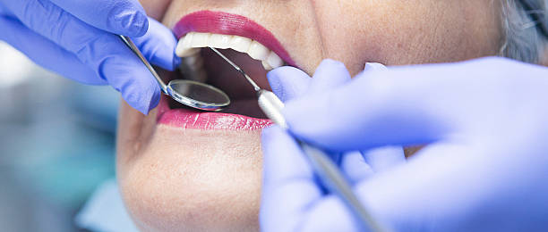 Best Knocked-Out Tooth (Avulsed Tooth) Treatment in Mount Pleasant, IA
